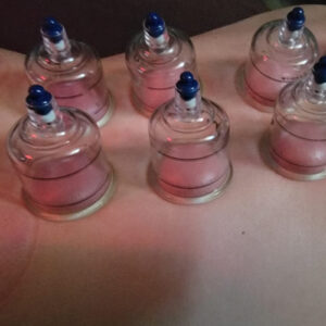 cupping therapy